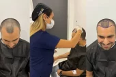 Türkiye Saç Ekimi Operasyonu (Hair Transplant Turkey) Hakkında Bilgiler